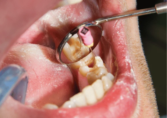 Dente danneggiato da una carie profonda