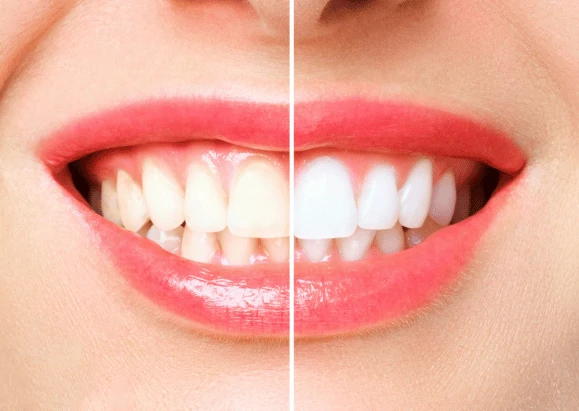 Sorriso prima e dopo lo sbiancamento