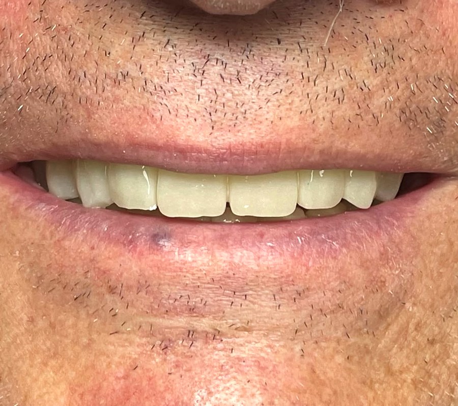 Dopo: denti fissi provvisori su impianti applicati in giornata