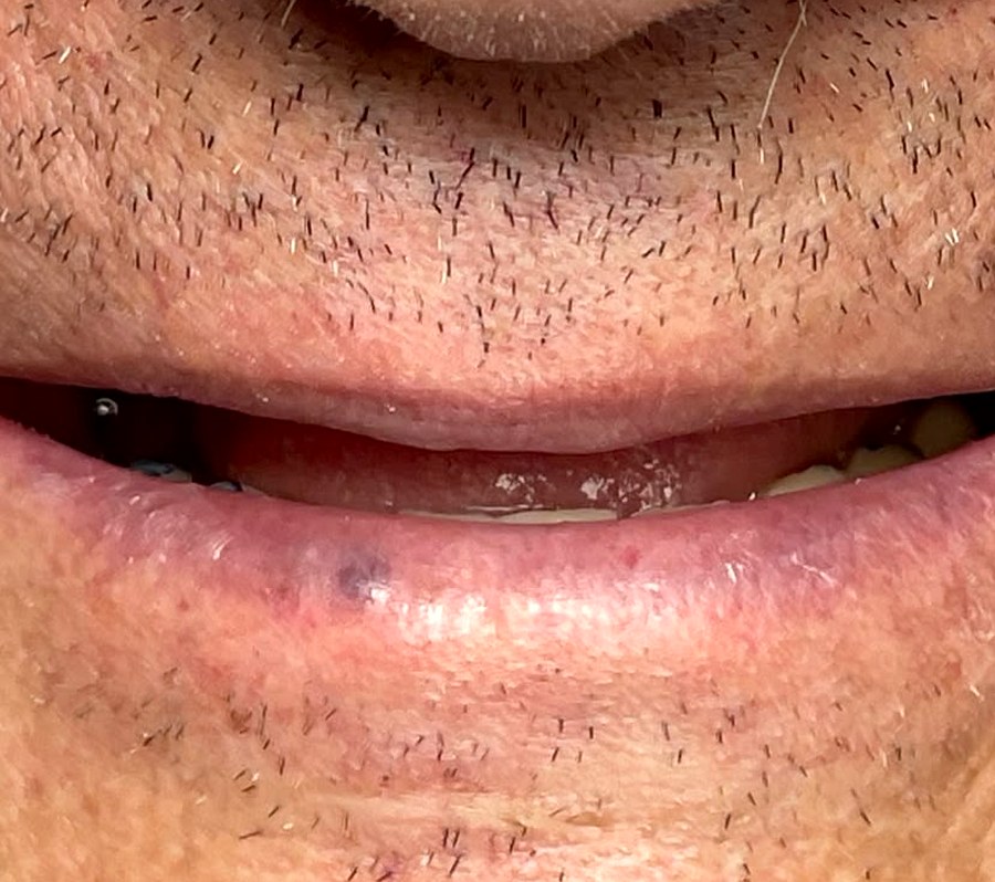 Prima: arcata superiore con pochi denti residui