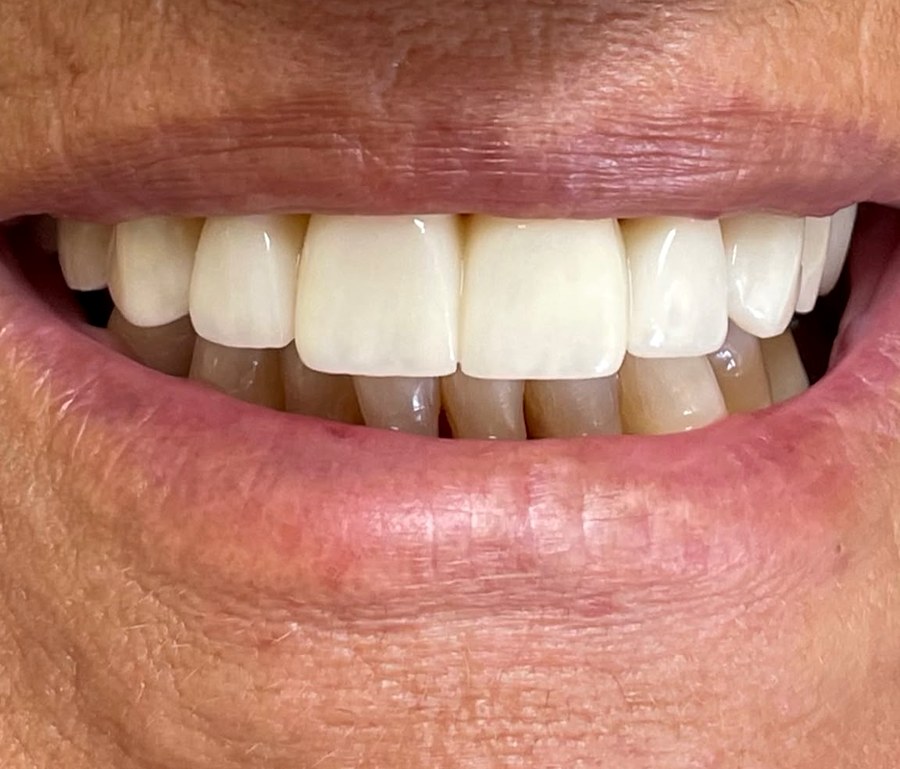 Caso 2 dopo: corone in ceramica sui denti anteriori superiori