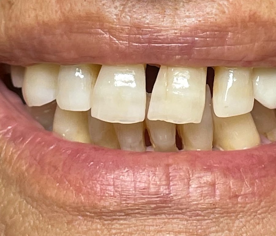 Caso 2 prima: spazi tra i denti anteriori superiori