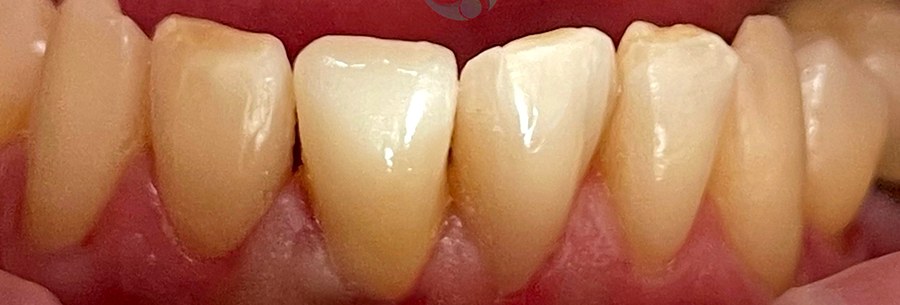 Caso 6 dopo: corona in ceramica e ricostruzioni dirette sugli incisivi inferiori